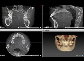 歯科用CT