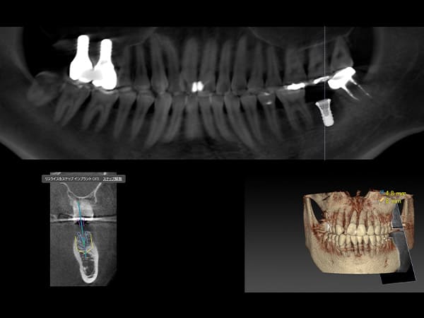 インプラントシミュレーションソフト