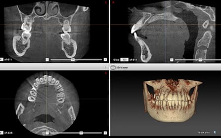 顎や歯の位置関係を立体的に把握できる歯科用CT画像