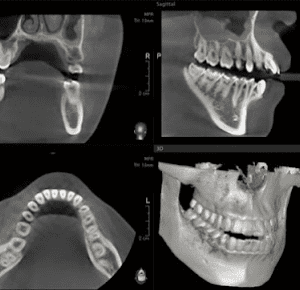 歯科用CT